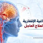 رسم طبي يوضح انسداد شريان بالمخ في السكتة الدماغية الإقفارية