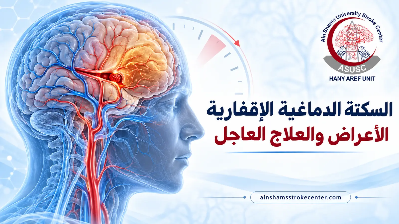 رسم طبي يوضح انسداد شريان بالمخ في السكتة الدماغية الإقفارية